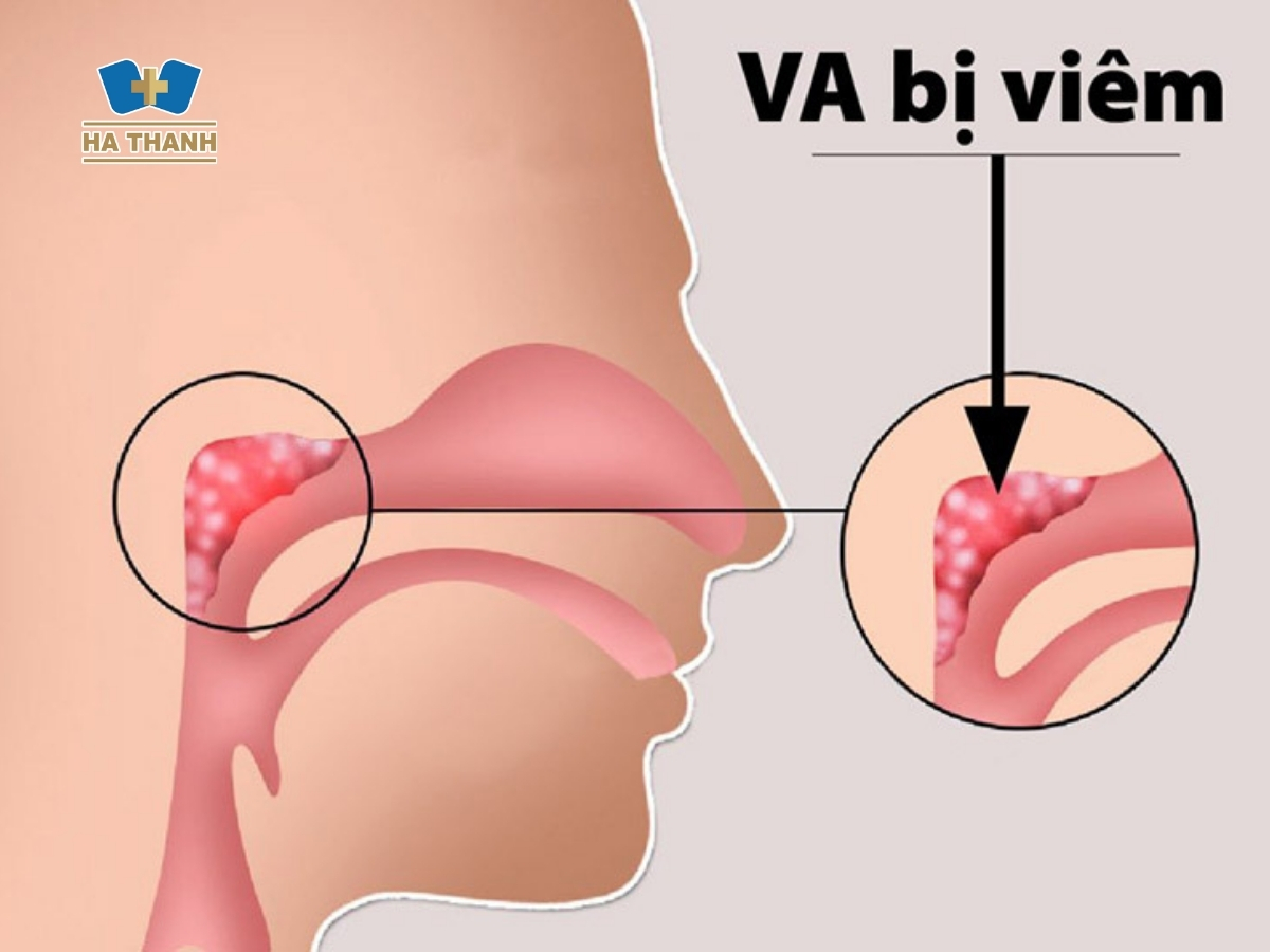 Đừng Xem Thường Viêm VA – Bệnh Lý Tai Mũi Họng Nguy Hiểm Ở Trẻ